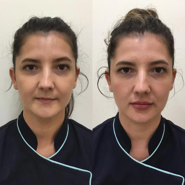 Hydrodermabrasion Facial Treatments Sydney Evolution Laser Clinic