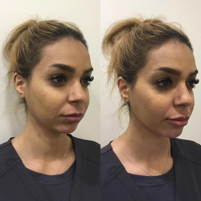 Hydrodermabrasion Facial Treatments Sydney Evolution Laser Clinic