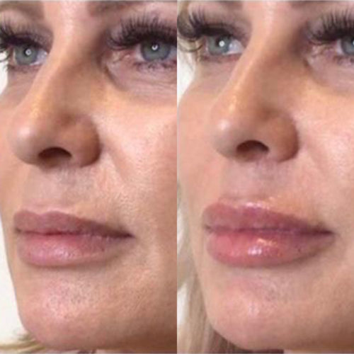 Microdermabrasion Sydney Best Microdermabrasion Facial ELC