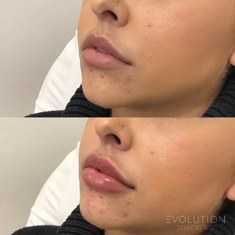 Lip Injections Sydney Best Lip Filler Treatment ELC