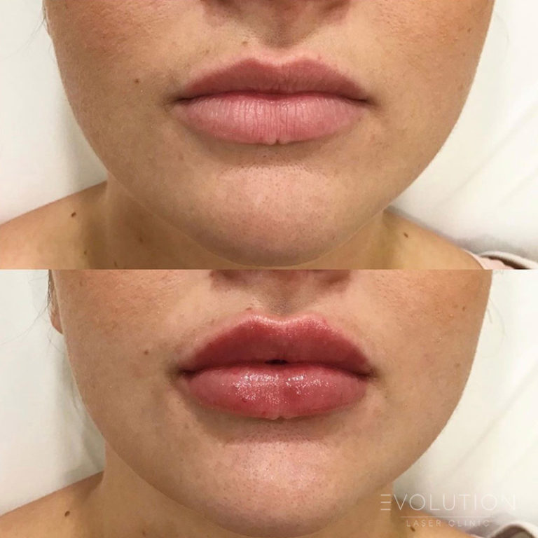 Lip Injections Sydney Best Lip Filler Treatment ELC