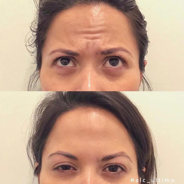 Hydrodermabrasion Facial Treatments Sydney Evolution Laser Clinic