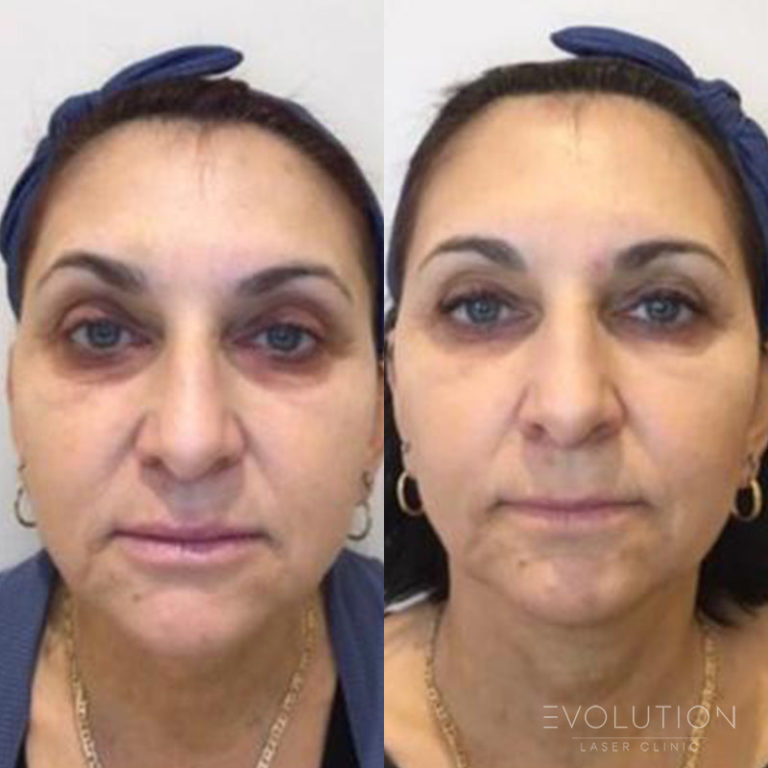 UnderEye Circles Treatment Sydney Evolution Laser