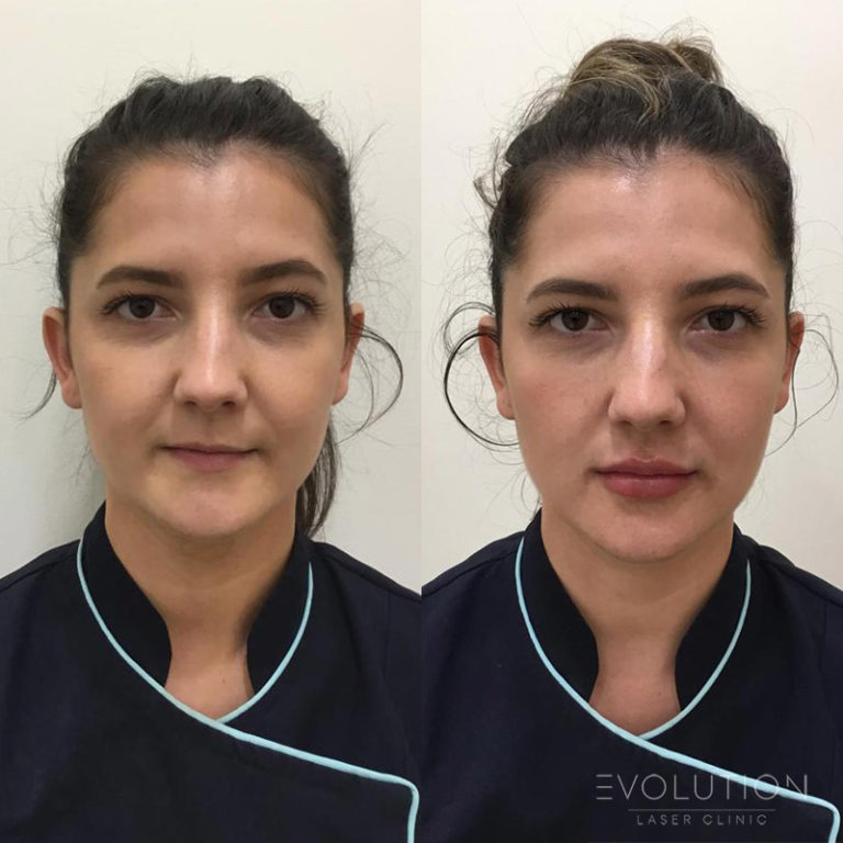 Lip Injections Sydney Lip Fillers Evolution Laser Clinic