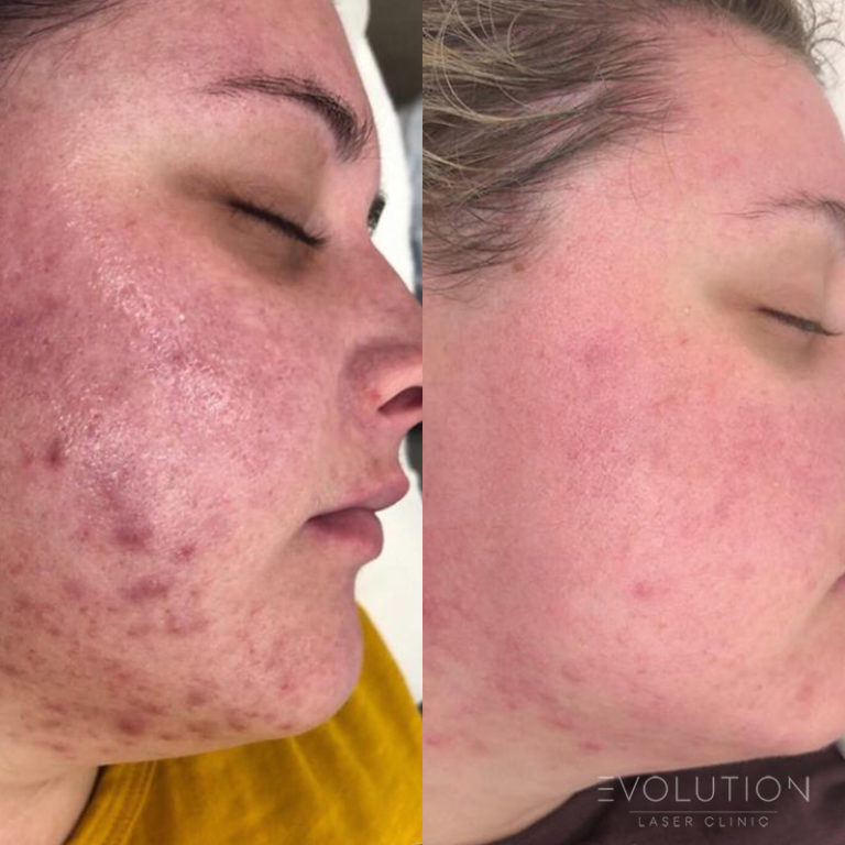 Acne Scar Treatment Sydney Laser Acne Scar Removal ELC