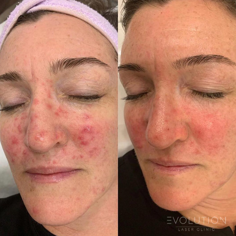 Acne Scar Treatment Sydney Laser Acne Scar Removal ELC