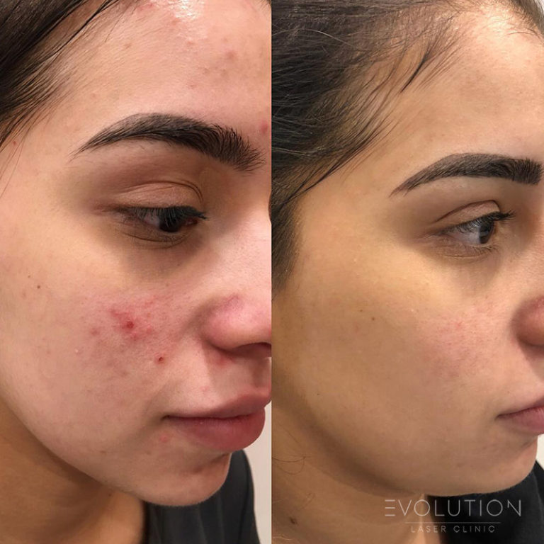 Acne Scar Treatment Sydney Laser Acne Scar Removal ELC