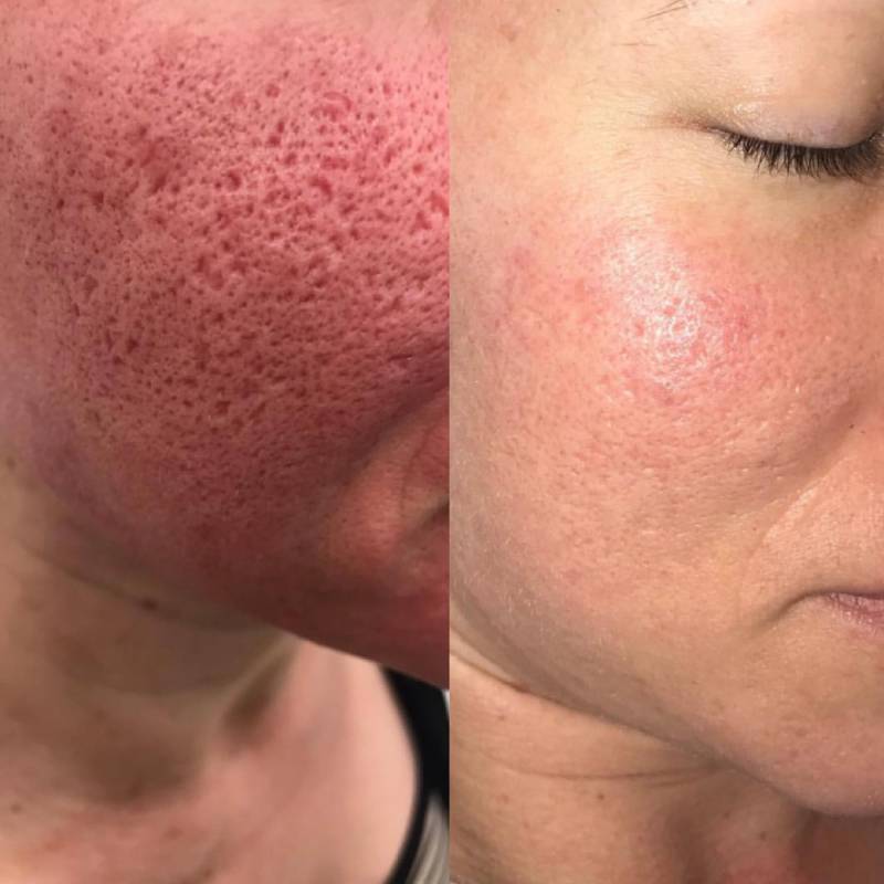 Enlarged Pores Treatment Laser Treatment For Pores Elc