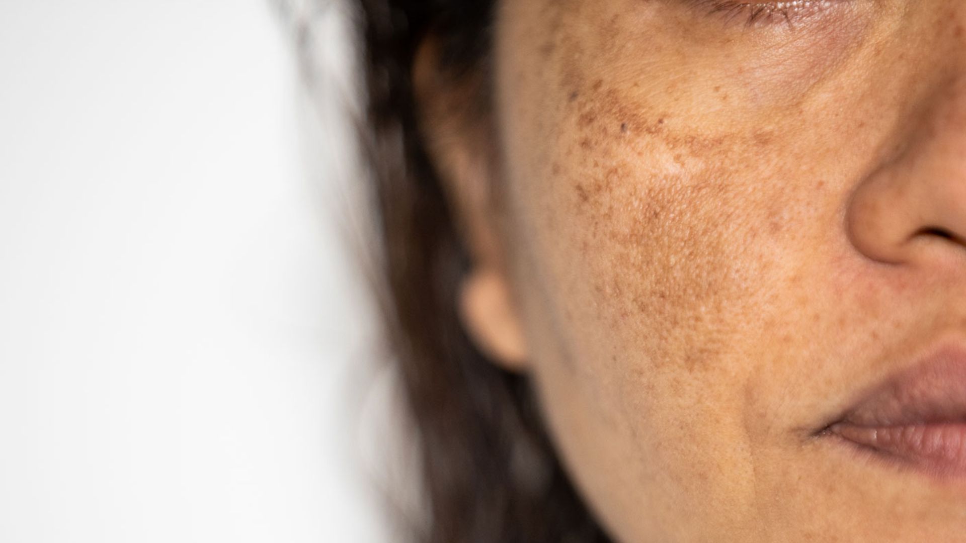 Melasma Treatment Sydney | Laser Treatment For Melasma | ELC