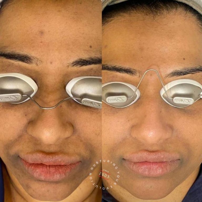 Melasma Treatment Sydney Laser Treatment For Melasma ELC