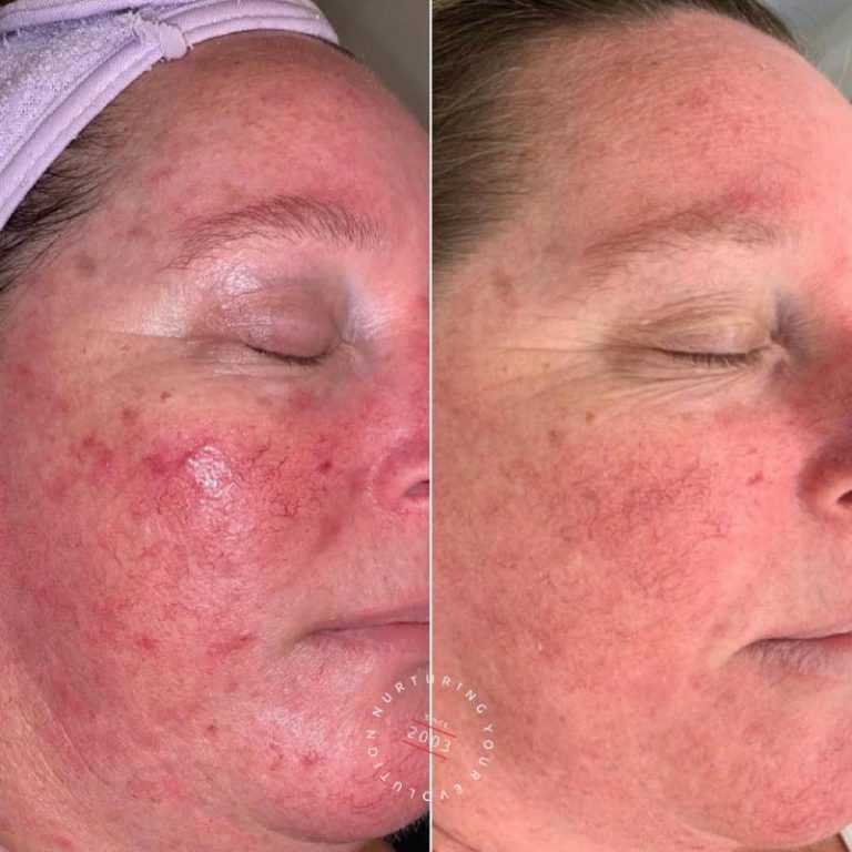 Treating Rosacea Laser Treatment For Rosacea ELC