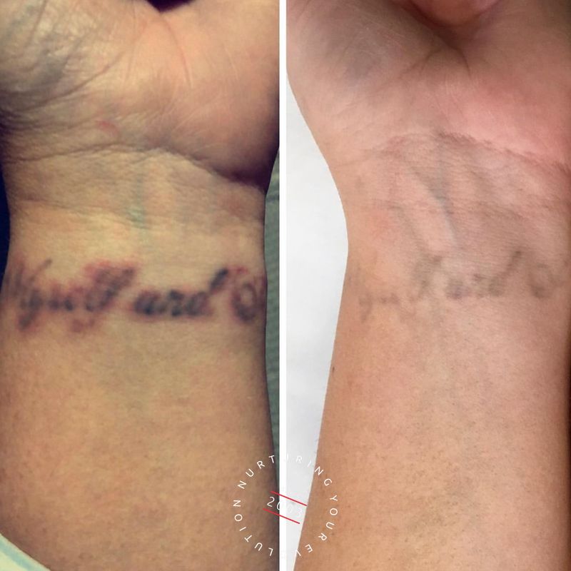 Laser Tattoo Removal Treatment Sydney | Evolution Laser Clinic
