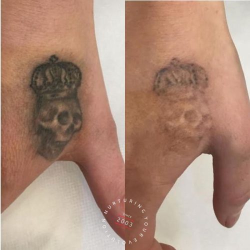 Laser Tattoo Removal Treatment Sydney Evolution Laser Clinic