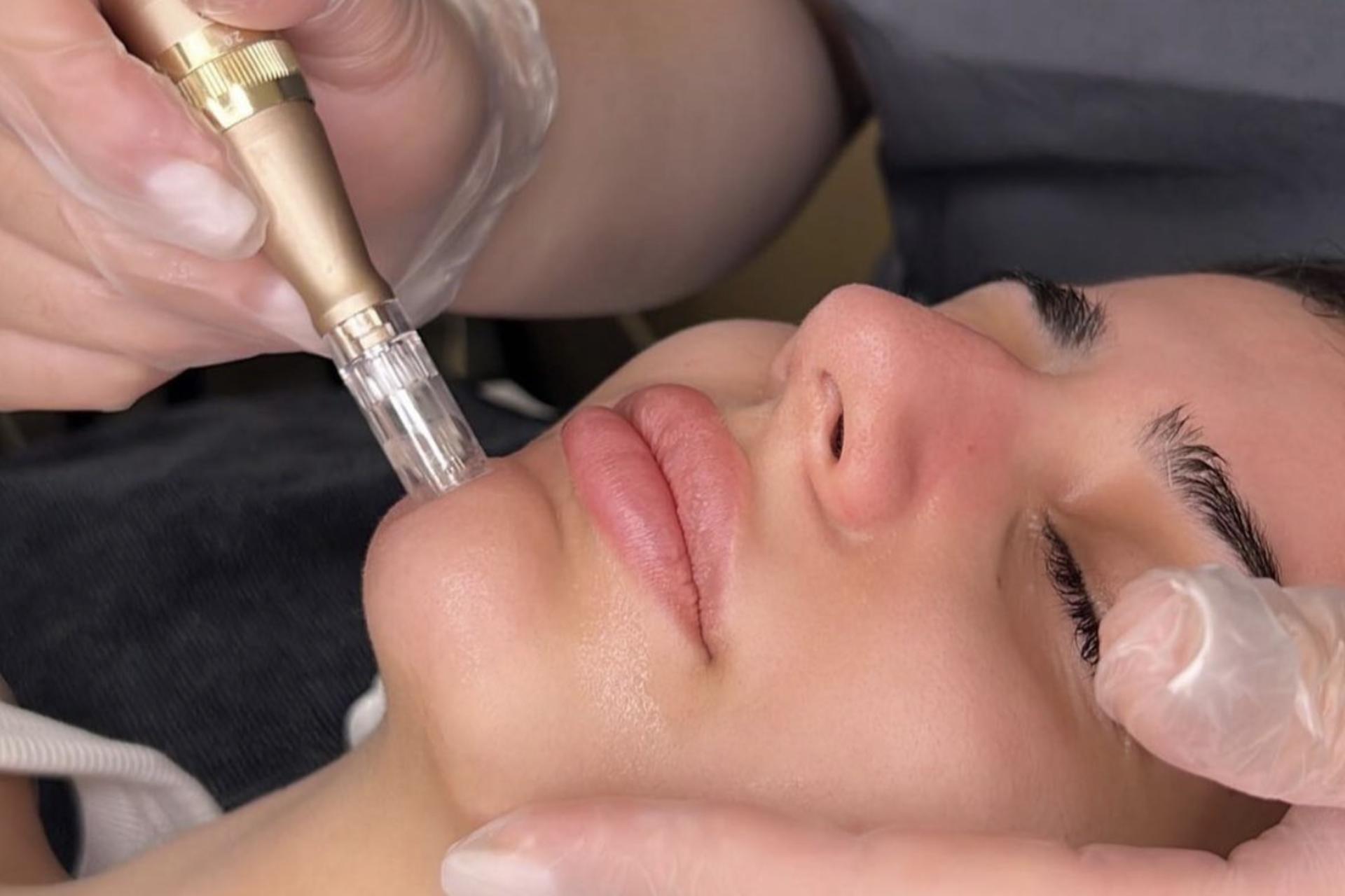 Your Complete Guide To The Benefits Of Skin Needling