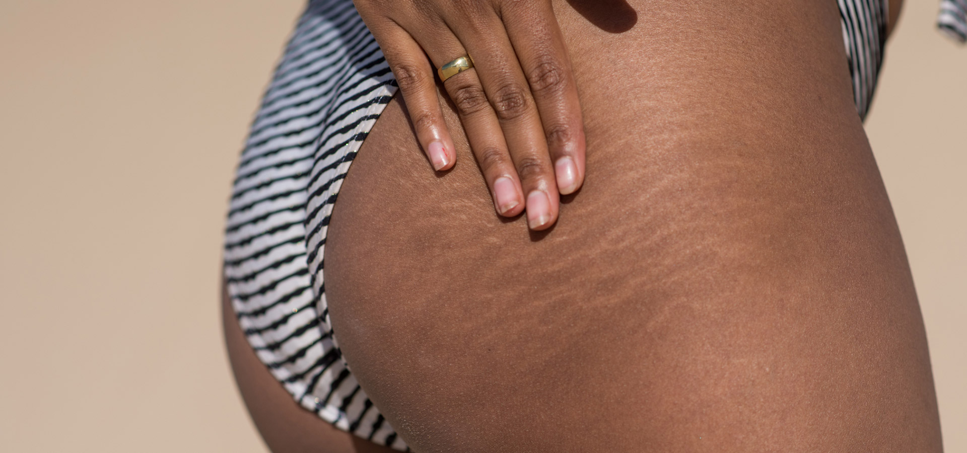 How to Get Rid of Stretch Marks: A Comprehensive Guide