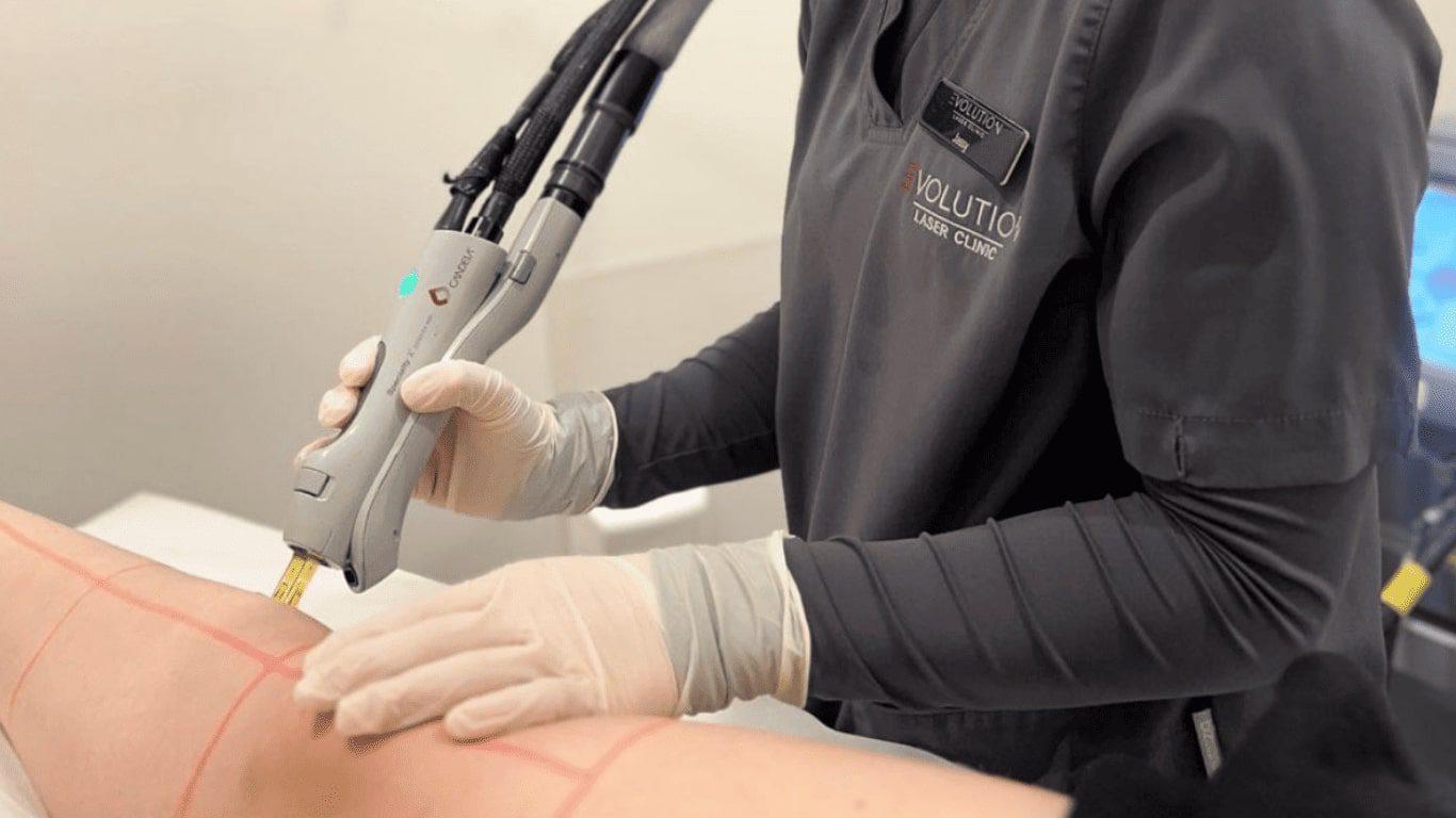 What Is Laser Hair Removal