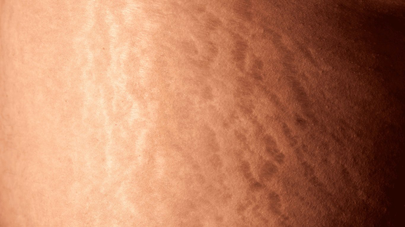 How Skin Needling Works on Stretch Marks