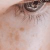 How to Treat Pigmentation and Texture Changes