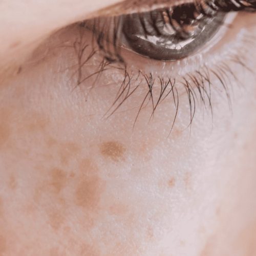 How to Treat Pigmentation and Texture Changes