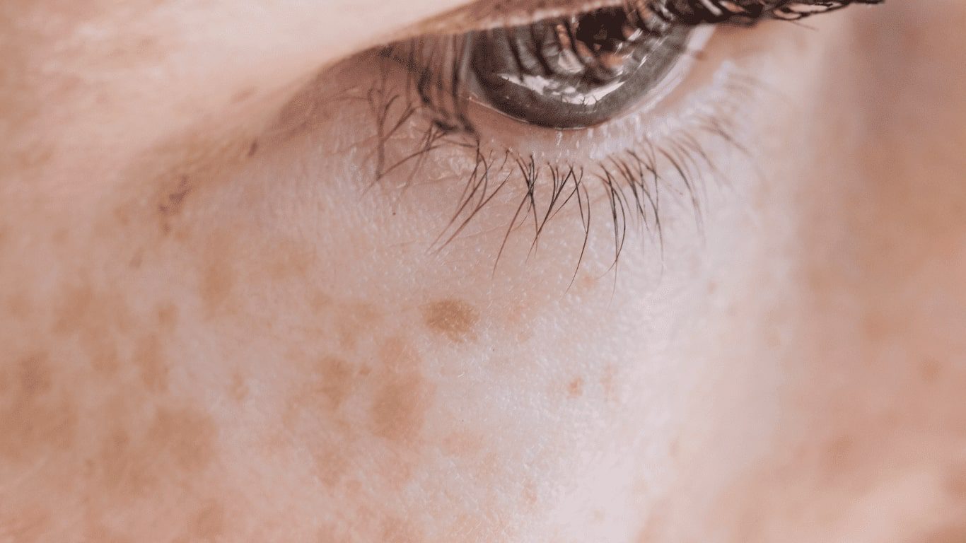 Postpartum Skin Concerns: How to Treat Pigmentation and Texture Changes