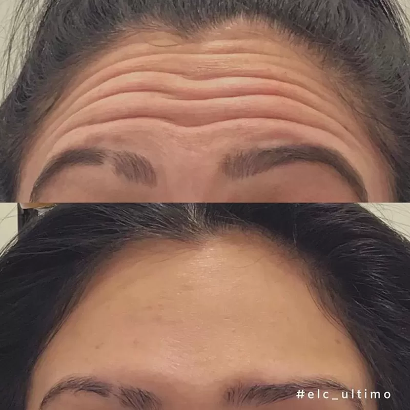 Anti-Wrinkle Injections