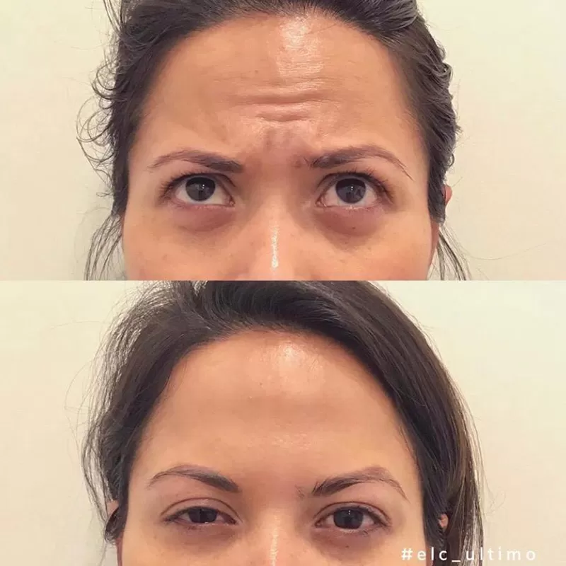 Anti-Wrinkle Injections