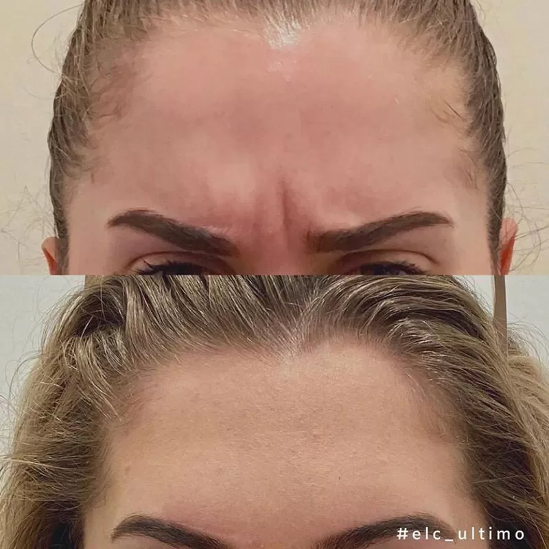 Anti-Wrinkle Injections