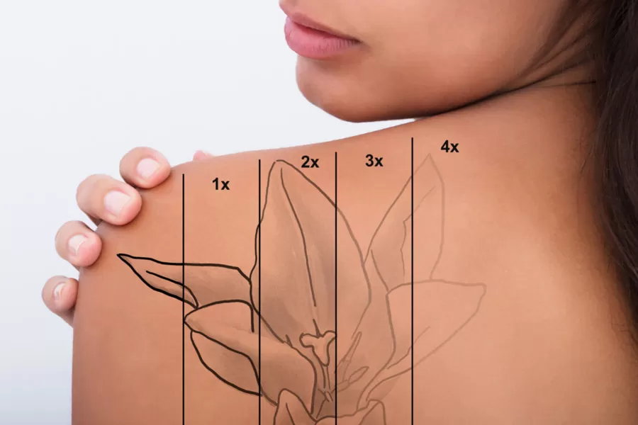Tattoo Removal