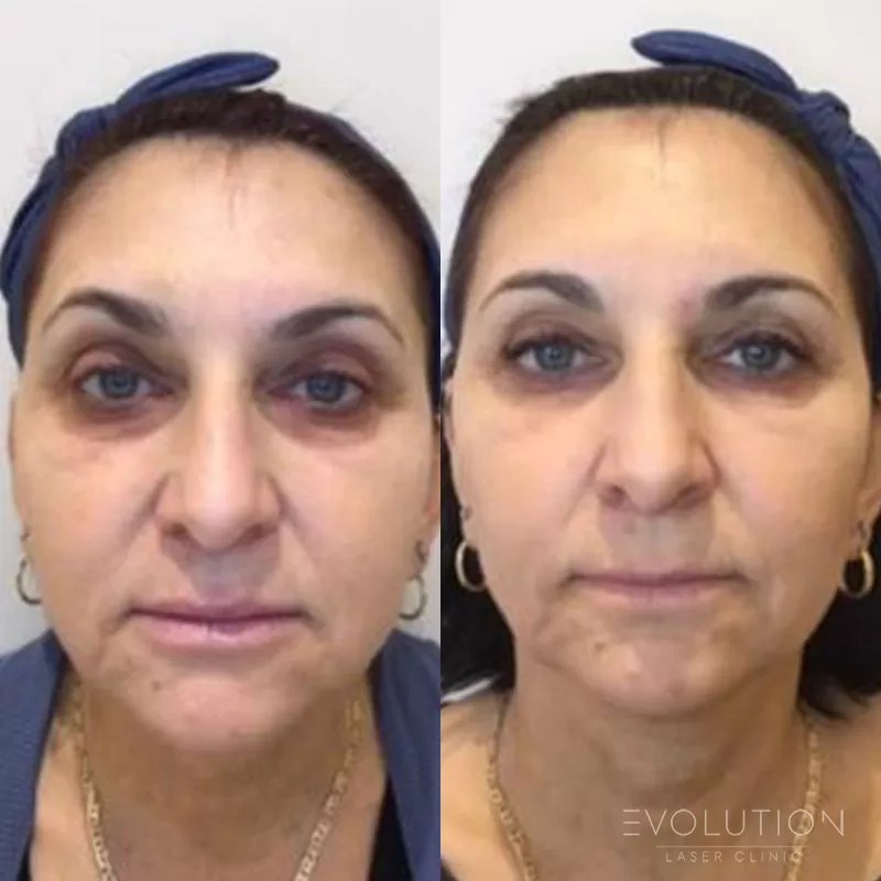Under-Eye Circles