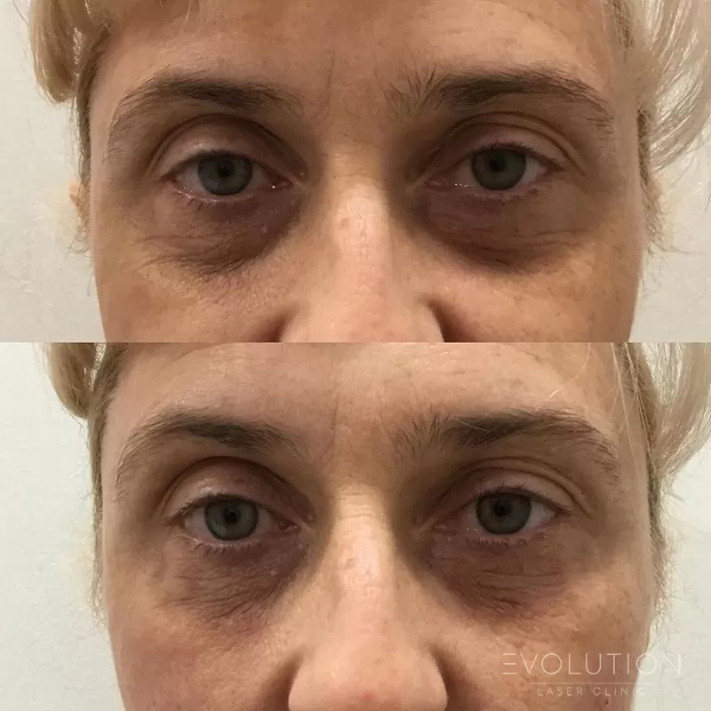 Under-Eye Circles