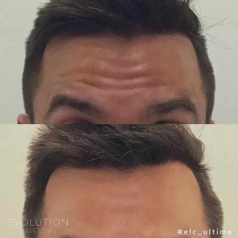Anti-Wrinkle Injections