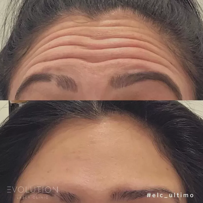 Anti-Wrinkle Injections