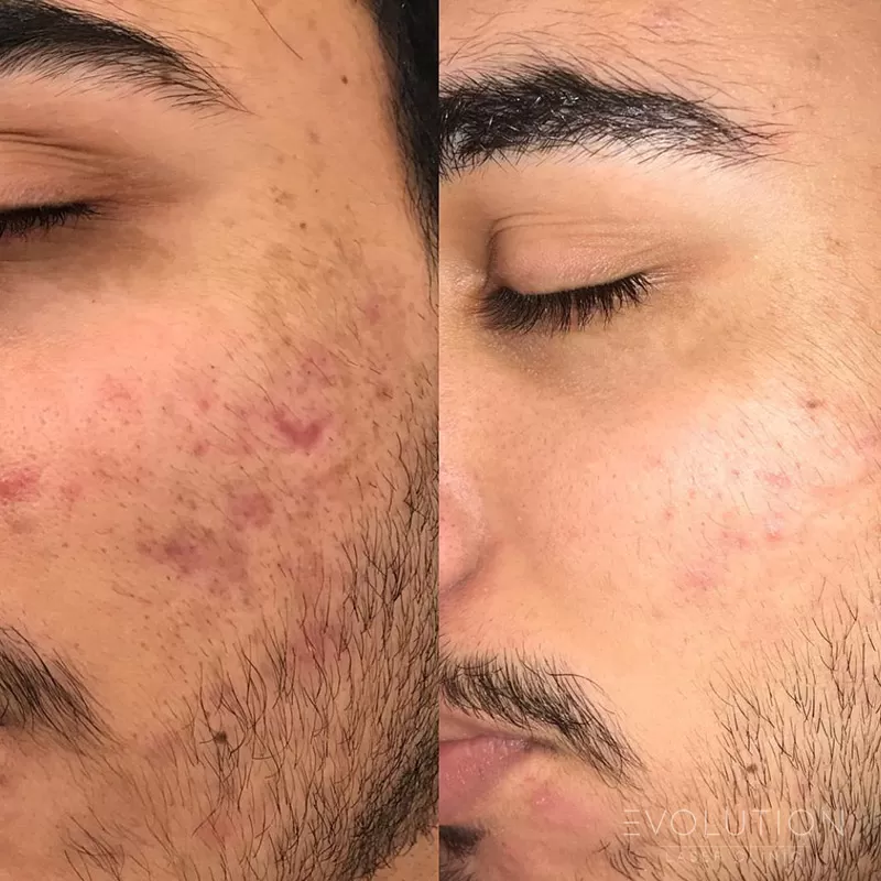 Acne Reduction