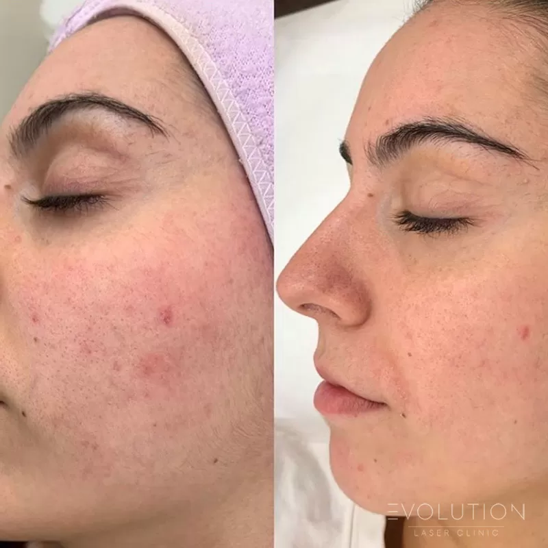 Acne Reduction Acne Reduction