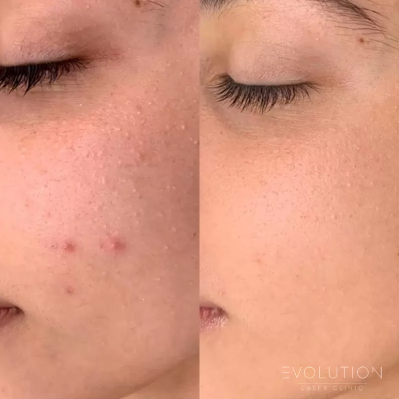 Acne Reduction