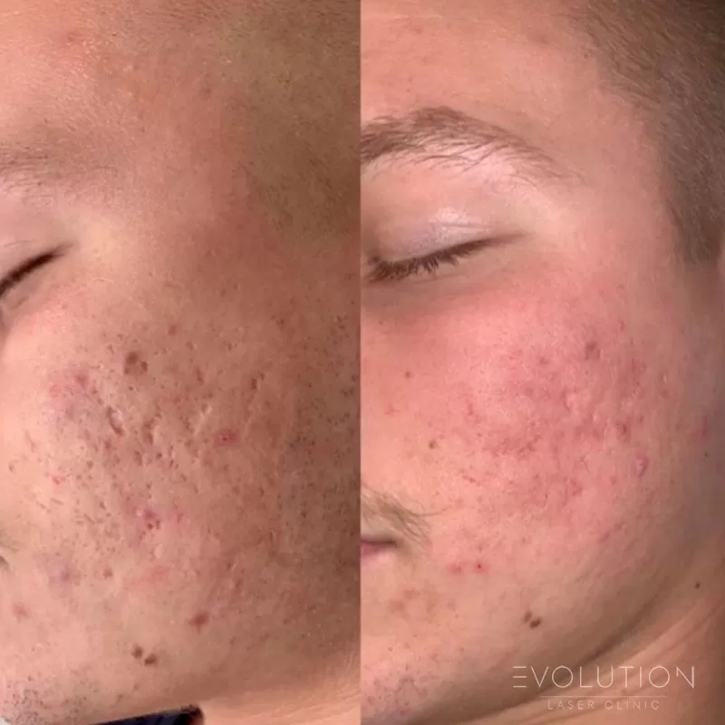 Acne Reduction