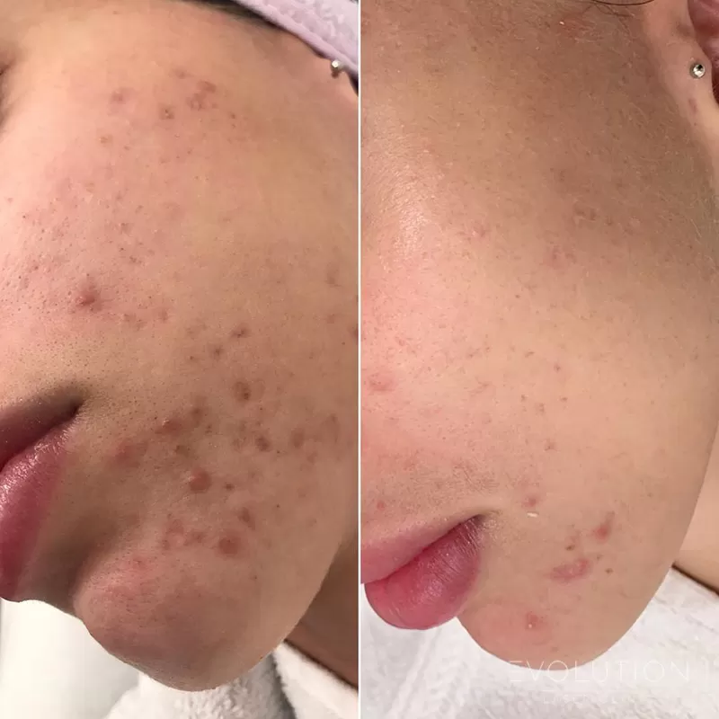 Acne Reduction Acne Reduction