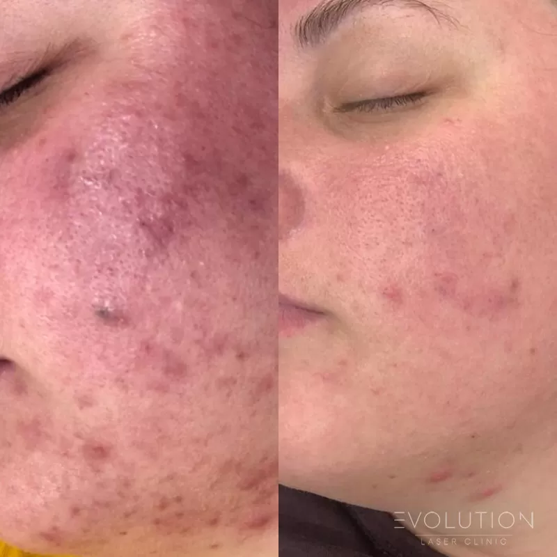 Acne Reduction Acne Reduction