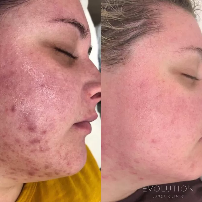 Acne Reduction Acne Reduction