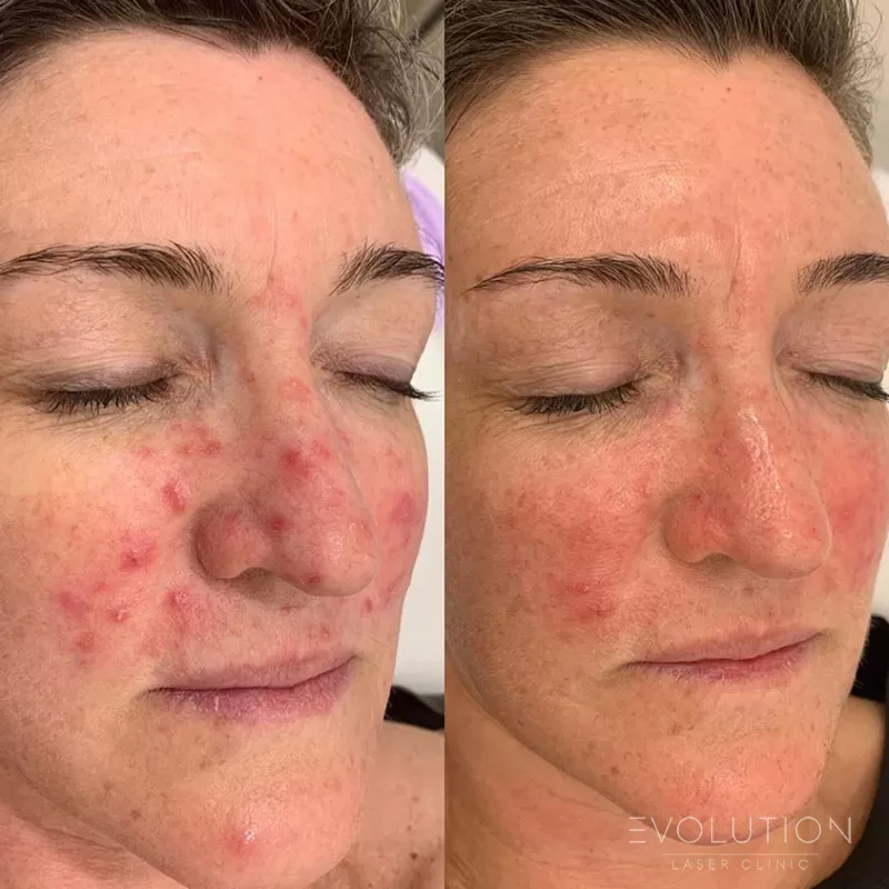 Acne Reduction Acne Reduction