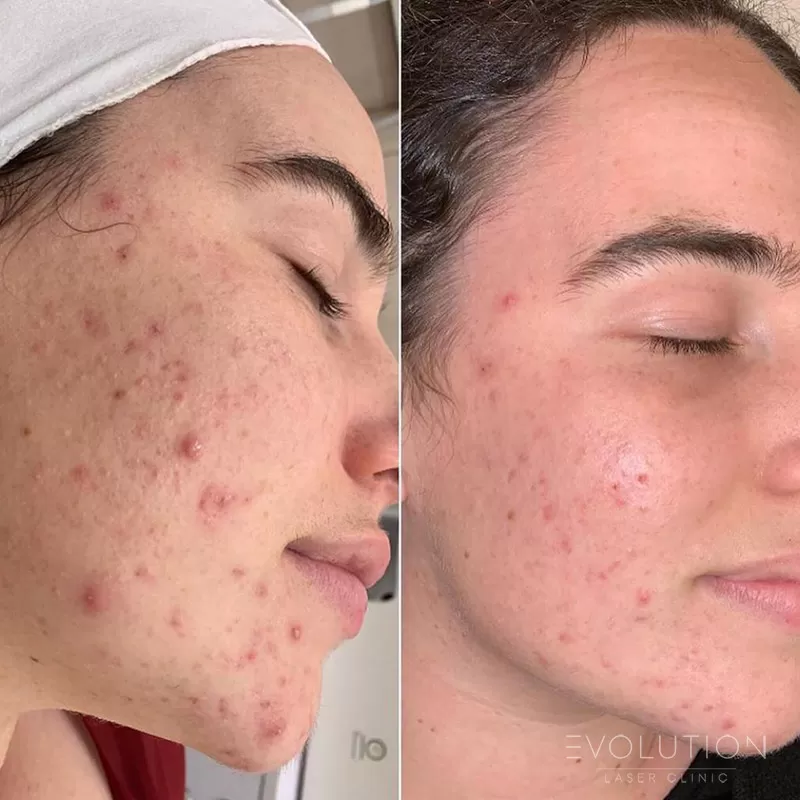 Acne Reduction