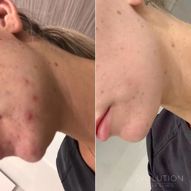 Acne Reduction Acne Reduction