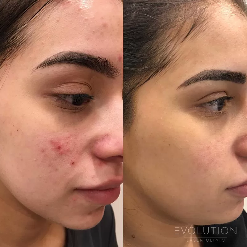 Acne Reduction Acne Reduction