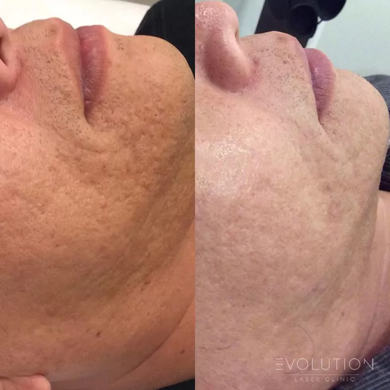 RF Skin Resurfacing