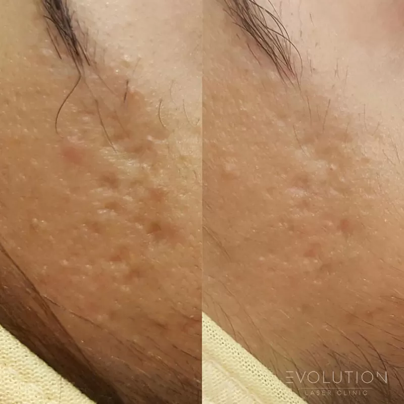 RF Skin Resurfacing