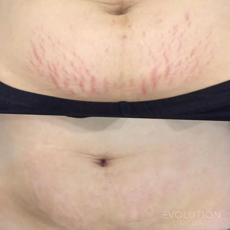 RF Skin Resurfacing
