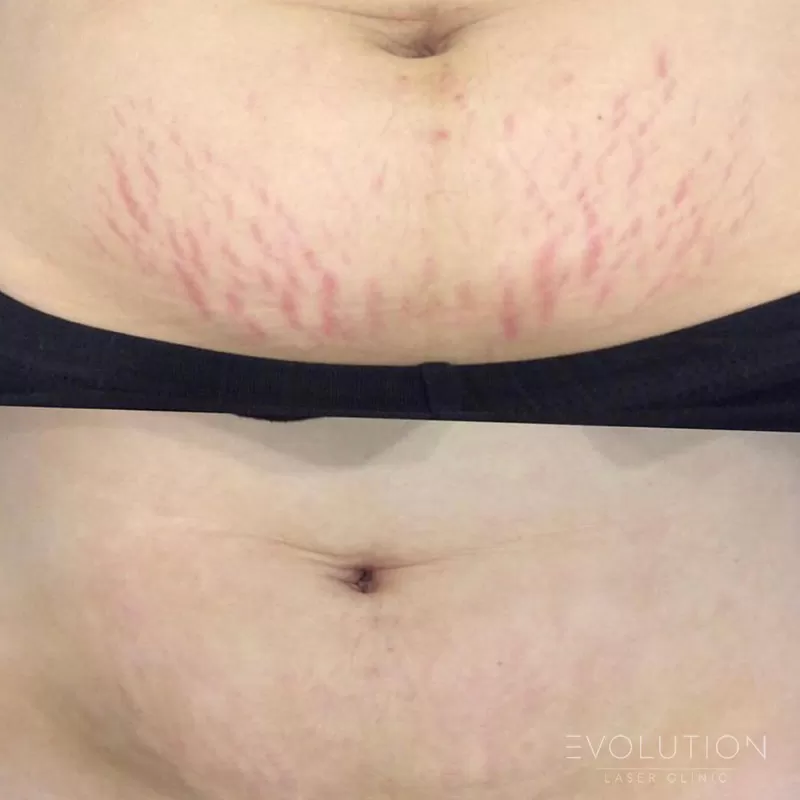 Stretchmark & Scar Reduction