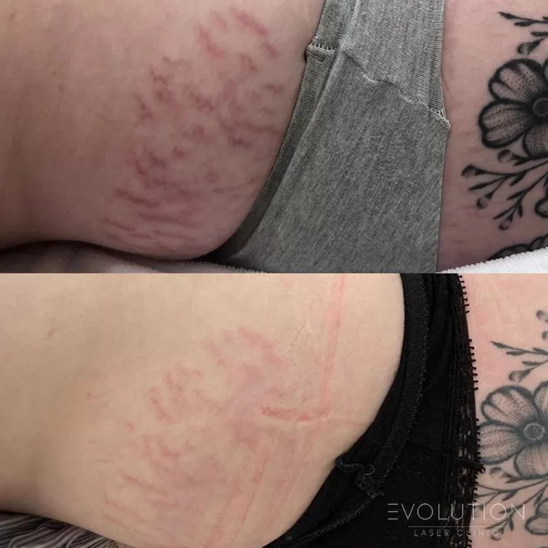 Stretchmark & Scar Reduction
