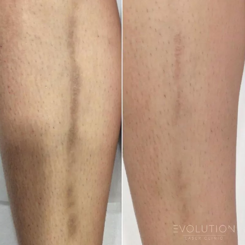 Stretchmark & Scar Reduction