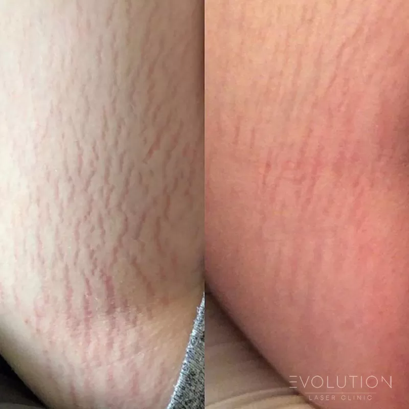 Stretchmark & Scar Reduction